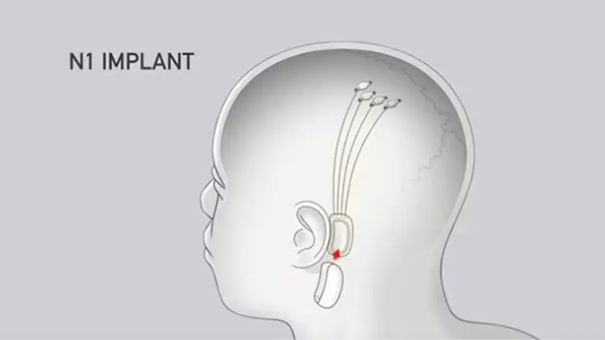 The Ethical and Security Challenges of Neuralink's Brain Implant Technology
