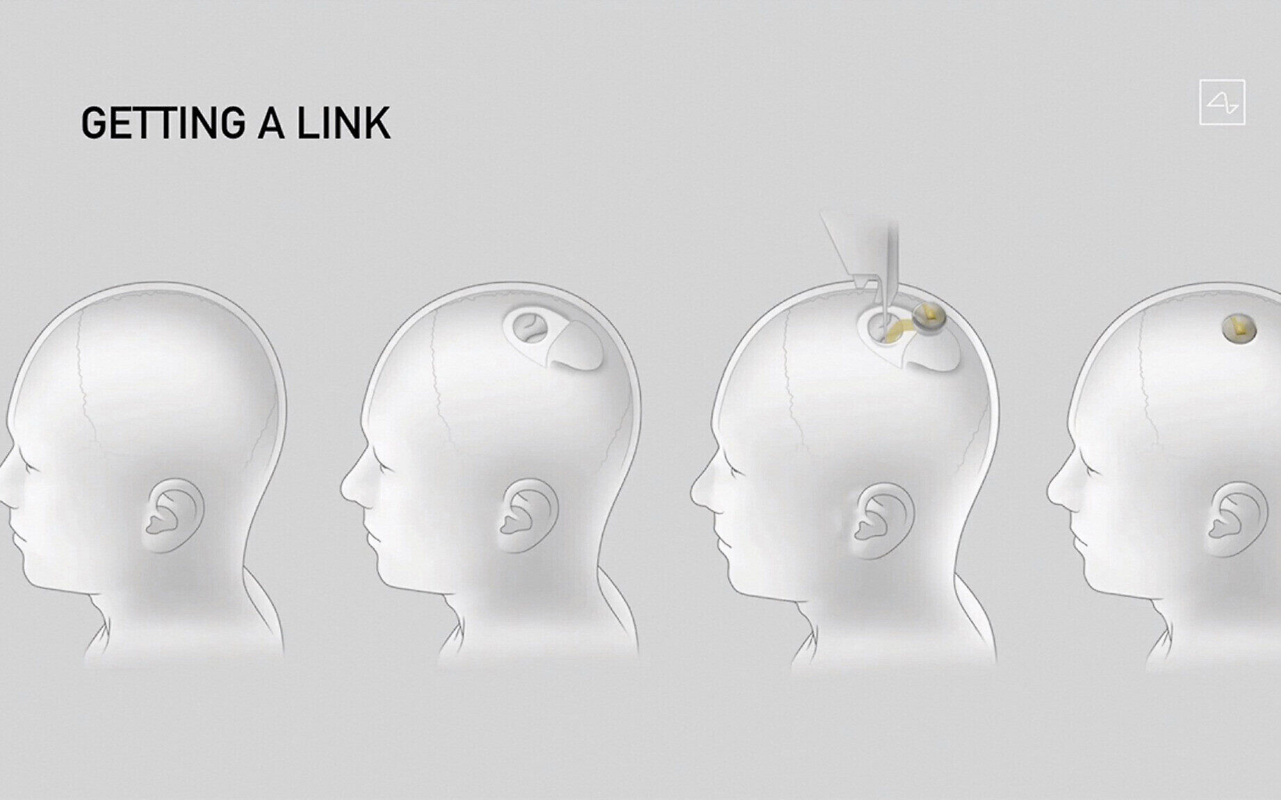 Neuralink has Begun Human Trials However Experts have Already Warned Elon Musk