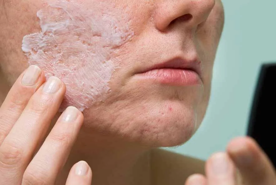 Alert: Your Acne Cream Might Be Risky! Shocking Findings on Benzene in Top Skincare Brands