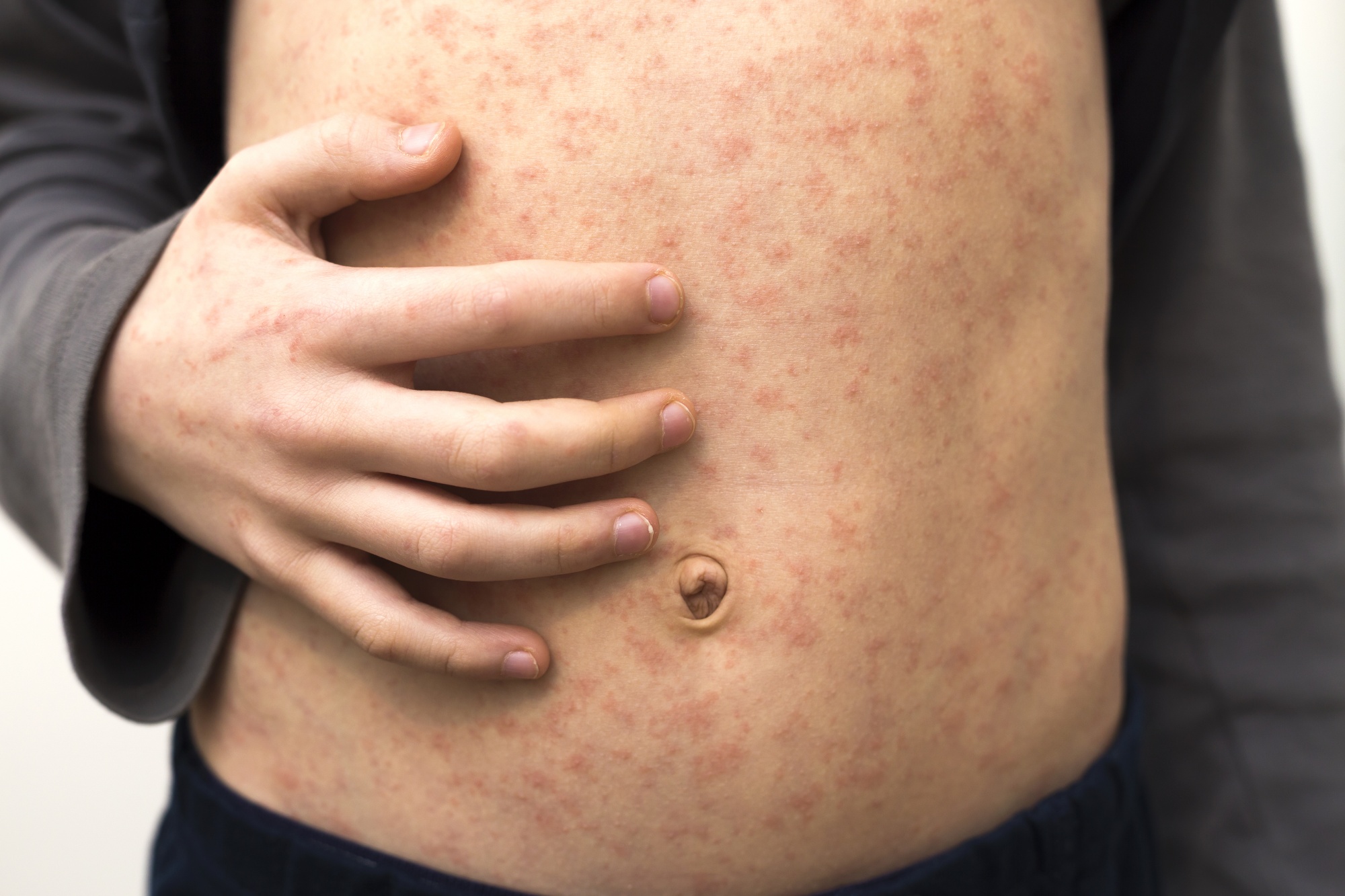 Measles Makes a Comeback: Why the U.S. Faces New Outbreaks and What It Means for Your Health