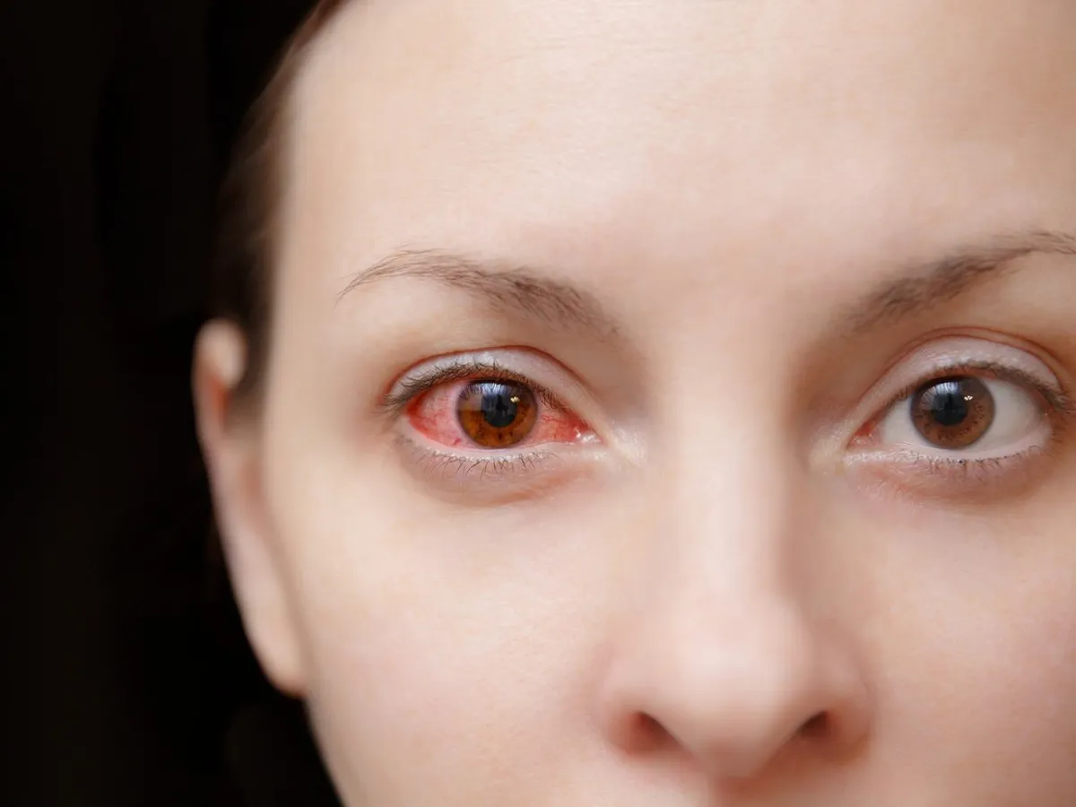 Rising STD Crisis: How Syphilis Is Threatening Vision Across the U.S